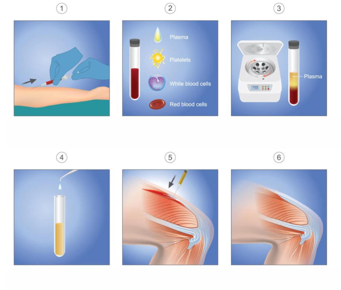 Six graphics that illustrate the steps involved with PRP Therapy. Image 1 shows blood being drawn from the arm. Image two breaks the blood down to plasma, platelets, white blood cells, and red blood cells. Image three shows a centrifuge and the plasma and