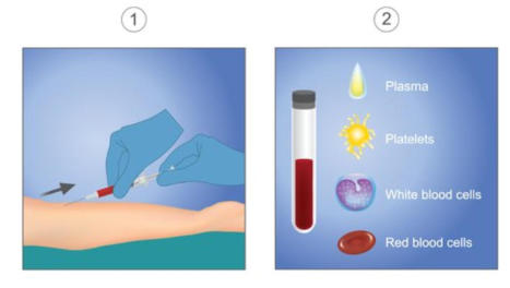 A graphic illustrating the first two steps in the PRP Therapy process. Image 1 shows blood being drawn. Image 2 breaks the blood down into its components - plasma, platelets, white blood cells, and red blood cells.