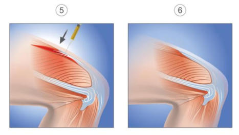 A graphic illustrating the last two steps in the PRP Therapy process. The first image shows a knee with the skin partially made transparent to show the injury in the muscle below. A syringe is injecting plasma into the knee. The final image shows the same