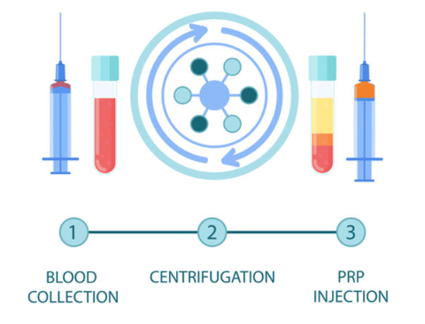 A graphic describing the PRP Process. On the left is a vial of blood and on the right is a vial with the platelet-rish plasma extracted from the blood. Three steps are listed out at the bottom: 1. Blood Collection, 2. Centrifugation, 3. PRP Injection