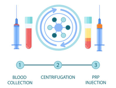 A graphic describing the PRP Process. On the left is a vial of blood and on the right is a vial with the platelet-rish plasma extracted from the blood. Three steps are listed out at the bottom: 1. Blood Collection, 2. Centrifugation, 3. PRP Injection
